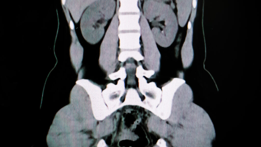 CT scan of the urinary system used in bladder cancer management.