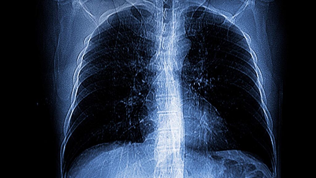 CT scan of chest