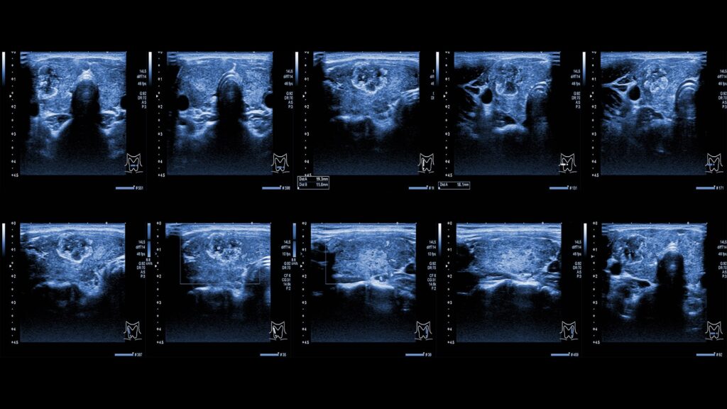 Ultrasound of the thyroid gland