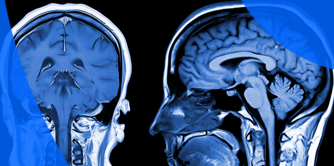 How to Read MRI Results - coronal and lateral of brain