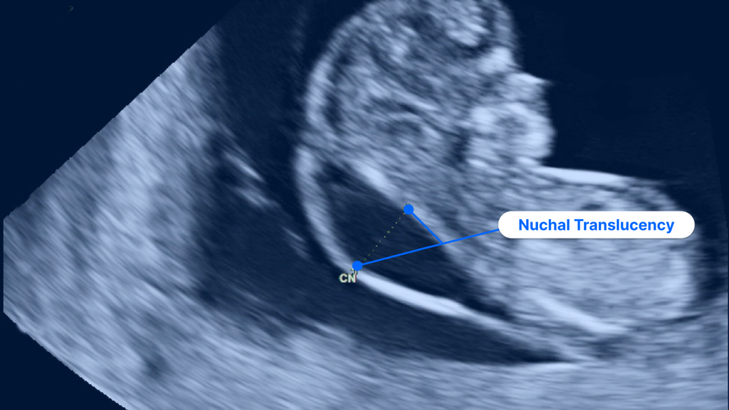Nuchal translucency ultrasound